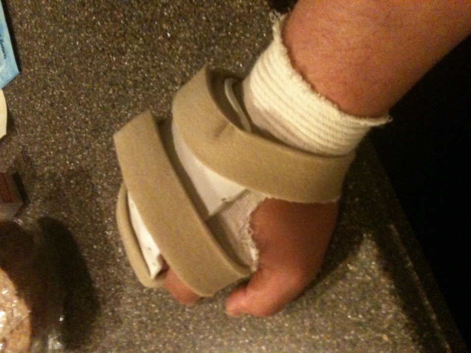 Permanent Splint